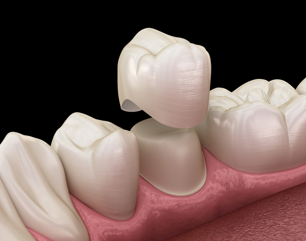 , Dental Crowns in 1 Hour by CEREC®