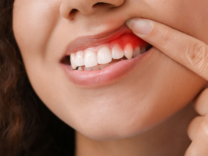 Woman-lifting-her-lip-with-finger-to-show-red-inflamed-gums-with-gum-disease