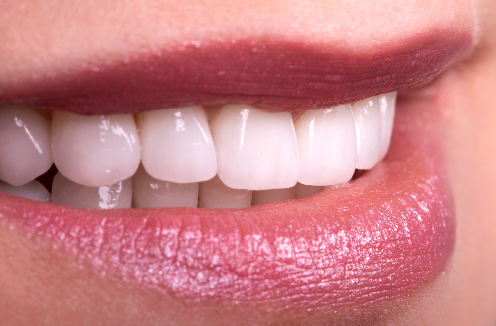 Cosmetic Teeth Bonding